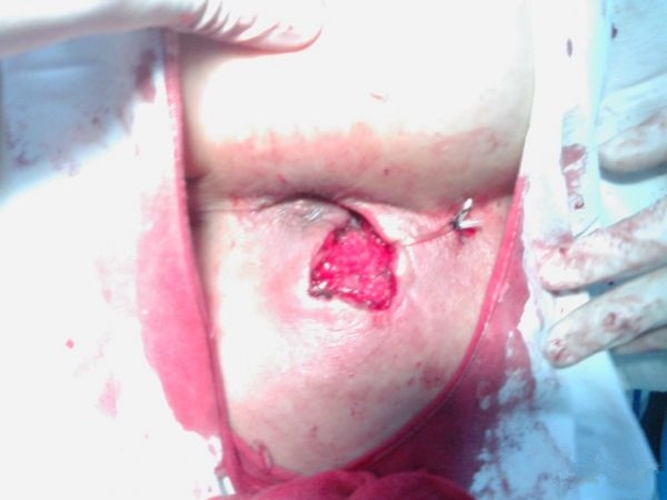 肛瘘手术要痛多久_肛瘘手术 多长时间不疼_疼多长手术肛瘘时间久