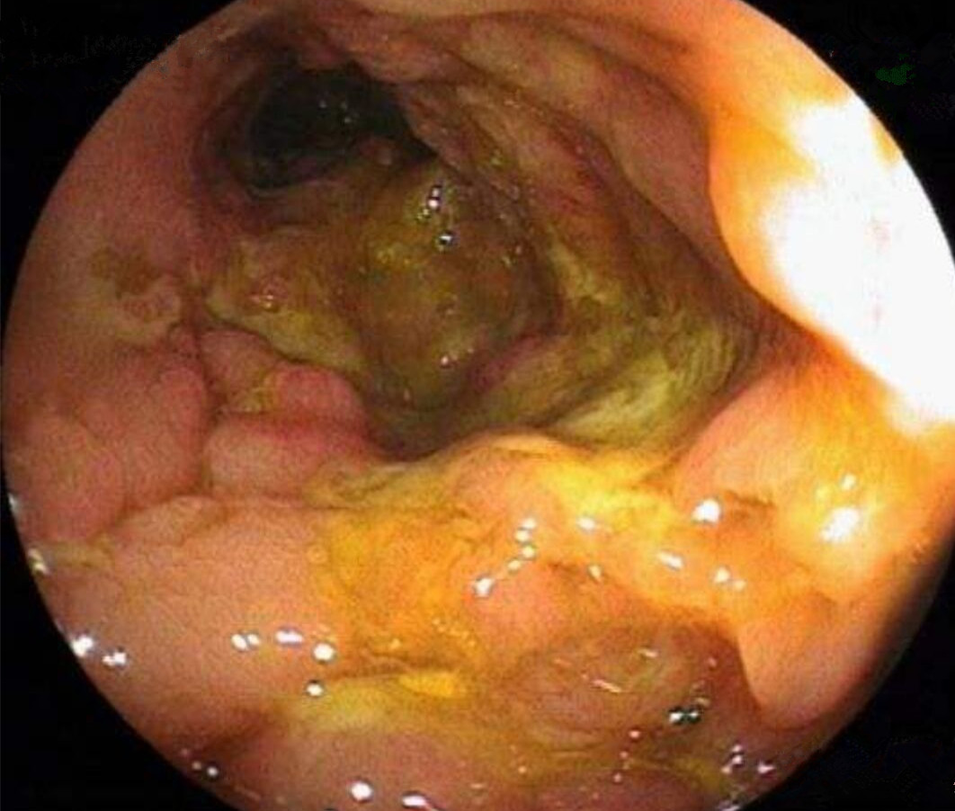 克罗恩氏病能活多久_可罗恩病_罗克罗恩病