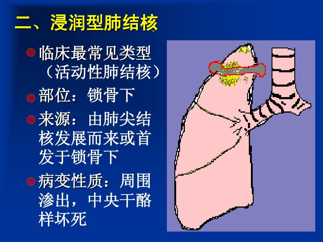 浸润型肺结核多久能好_浸润型肺结核一定会传染吗_浸润型肺结核能自愈吗