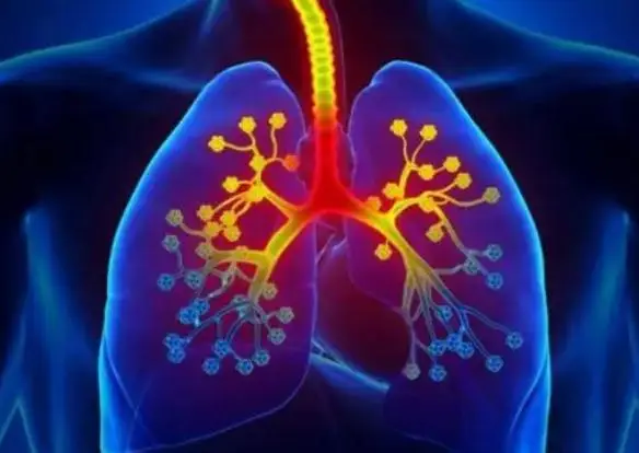 肺炎黄痰和白痰有什么区别_肺炎黄痰变白痰但是不好咳出_黄痰 白痰 肺炎