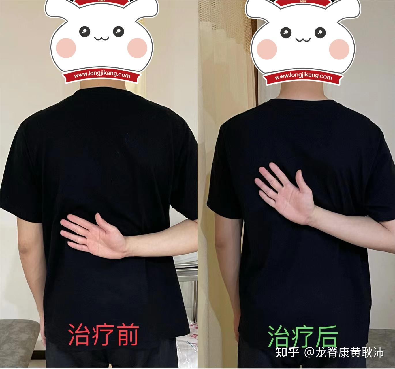 后背回事酸疼怎么办_后背回事酸疼怎么回事_后背酸疼怎么回事