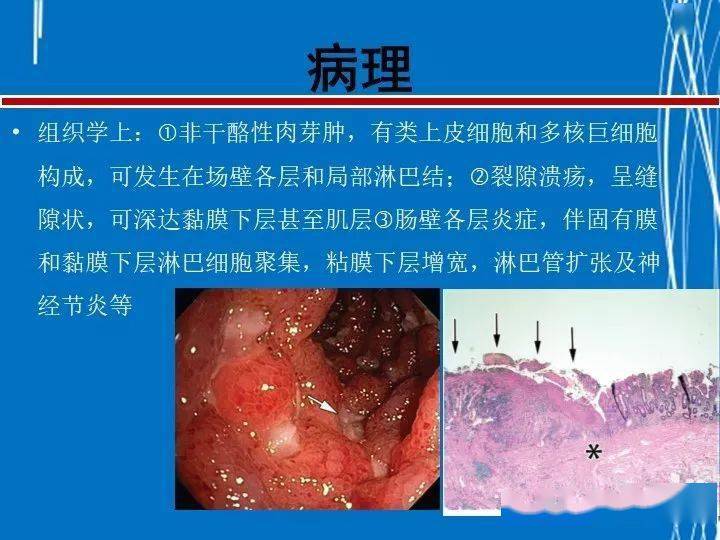 罗克恩病怎么确诊_罗克罗恩病_克罗恩病 ct