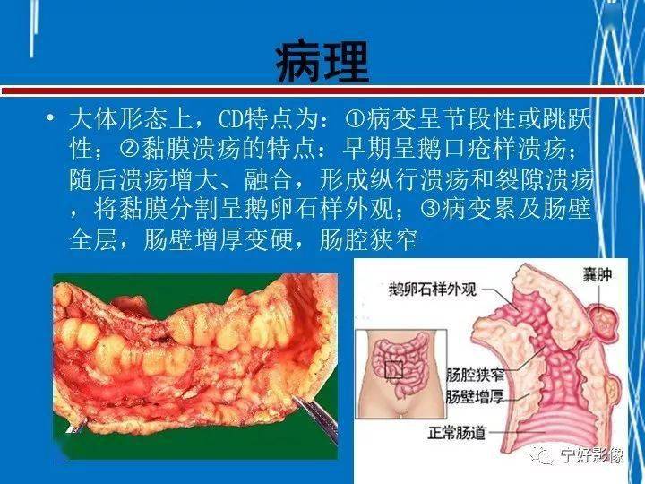 罗克罗恩病_克罗恩病 ct_罗克恩病怎么确诊