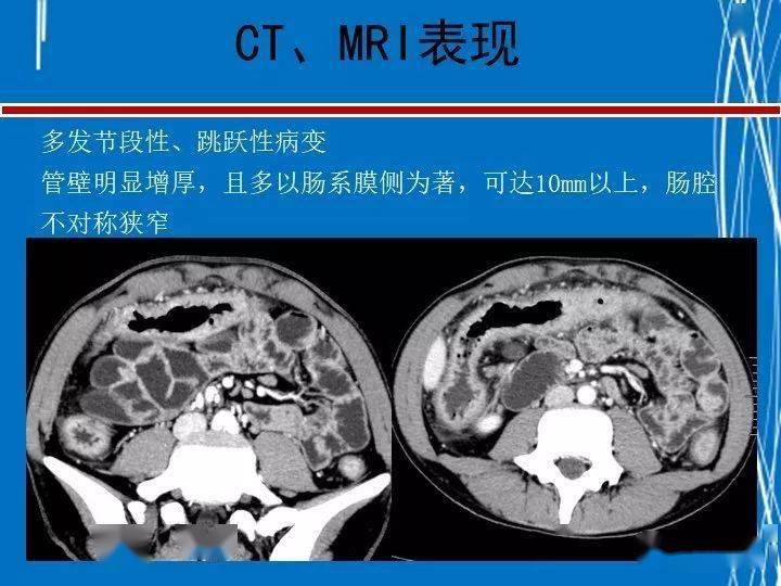 罗克罗恩病_克罗恩病 ct_罗克恩病怎么确诊