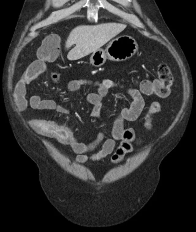 克罗恩病的六大标准_罗克罗恩病_罗克罗恩病的特征性体征