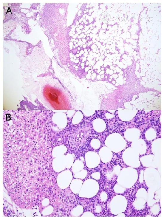 克罗恩病真的能痊愈吗？专家解读与病友经验分享