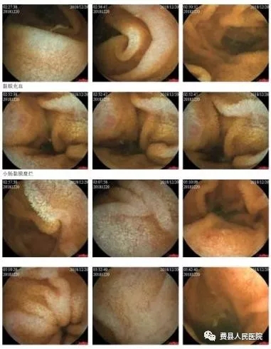 克罗恩病：不容忽视的肠道疾病，严重影响生活质量