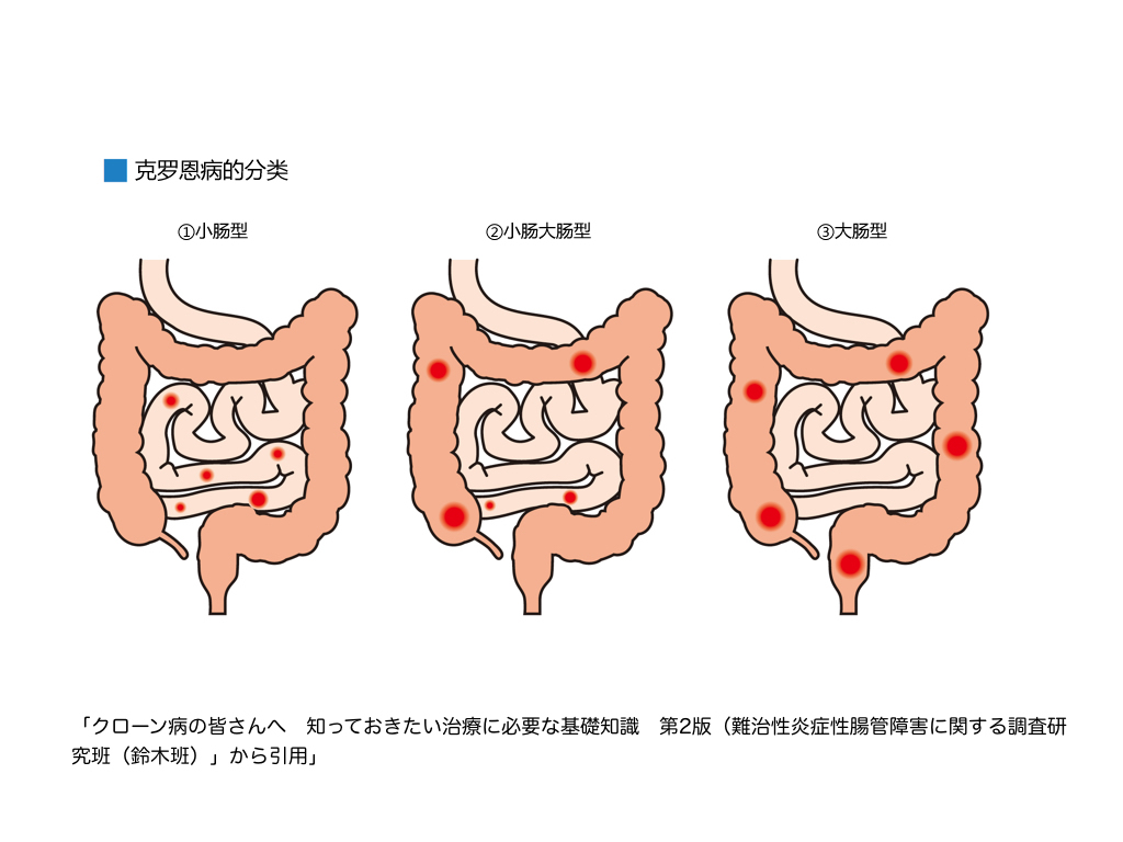 了解克罗恩病：症状、影响与应对方法