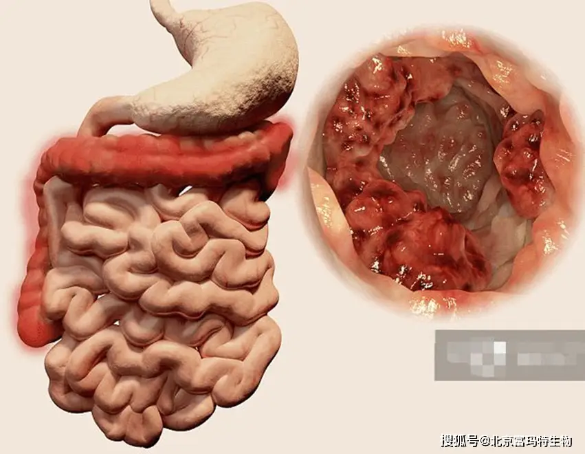 克罗恩病完整诊断_罗克恩病怎么确诊_诊断克罗恩的标准