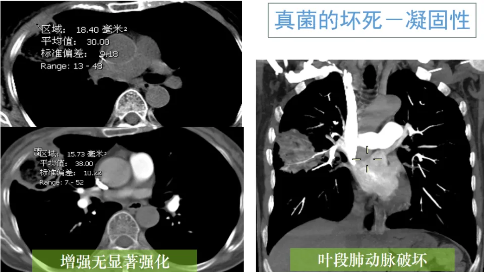 怎样会患上三型肺结核_肺结核会引起其它病吗_肺结核会更容易感染新型肺炎吗