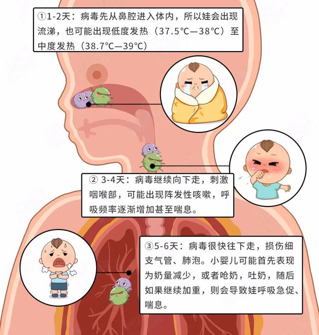 呼吸道合胞病毒肺炎_呼吸合胞病毒性肺炎_呼吸道合胞病毒肺炎