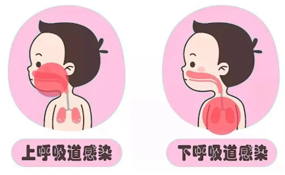 呼吸道合胞病毒肺炎_呼吸合胞病毒性肺炎_呼吸道合胞病毒肺炎
